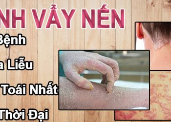 bệnh vẩy nến