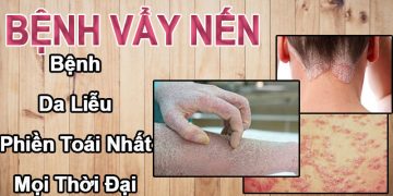 bệnh vẩy nến