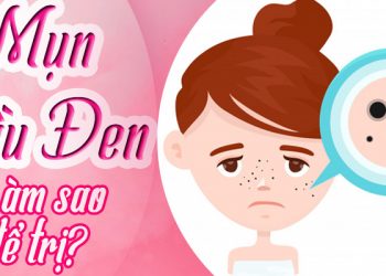 cách trị mụn đầu đen