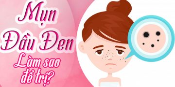 cách trị mụn đầu đen