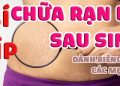 cách chữa rạn da sau sinh