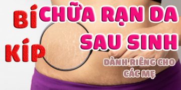 cách chữa rạn da sau sinh